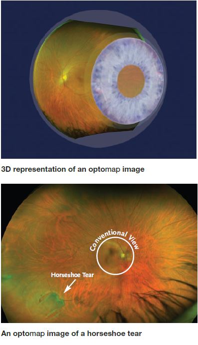 optomap® Retinal Imaging