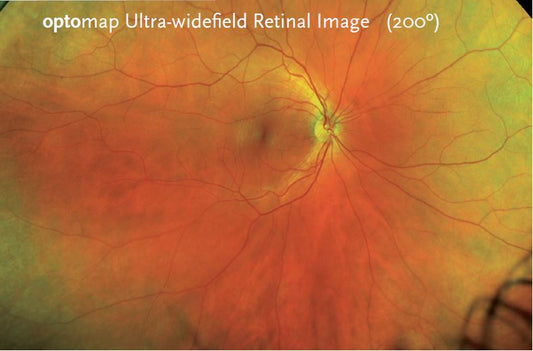 optomap® Retinal Imaging – Richmond Centre Optometry