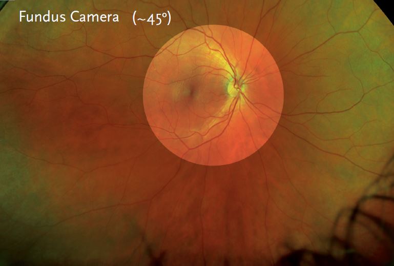 optomap® Retinal Imaging