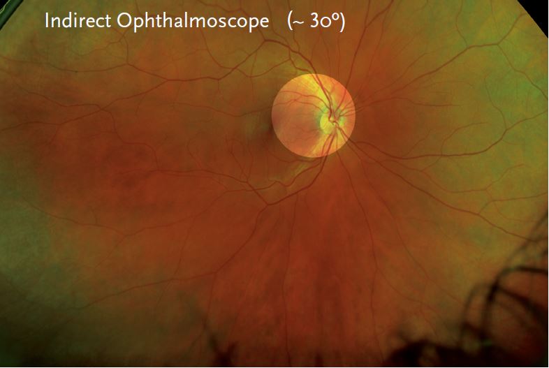 optomap® Retinal Imaging