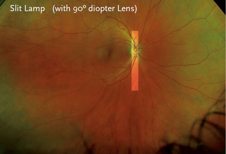 optomap® Retinal Imaging