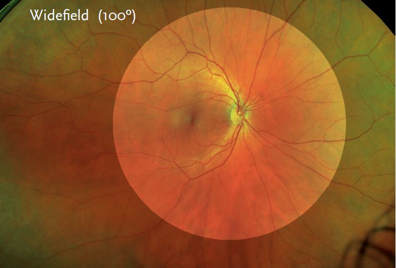 optomap® Retinal Imaging