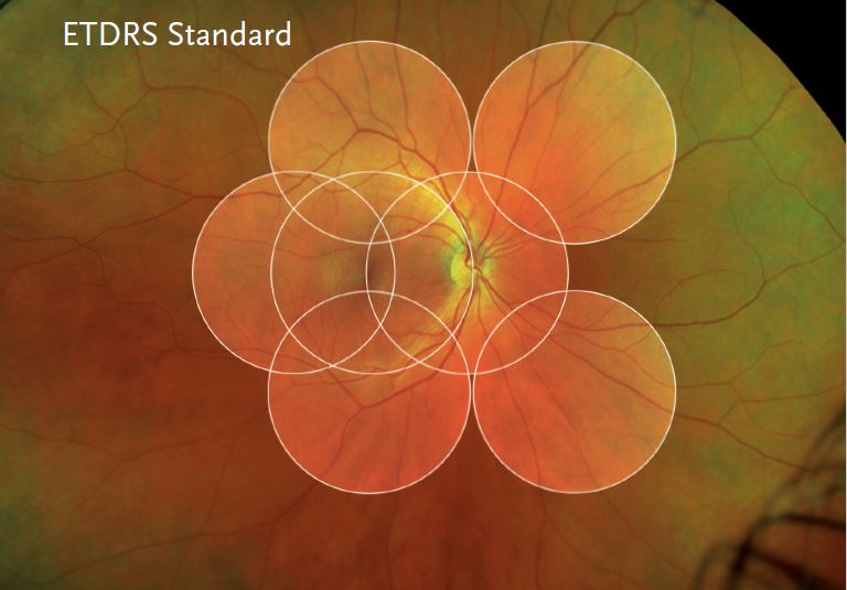 optomap® Retinal Imaging